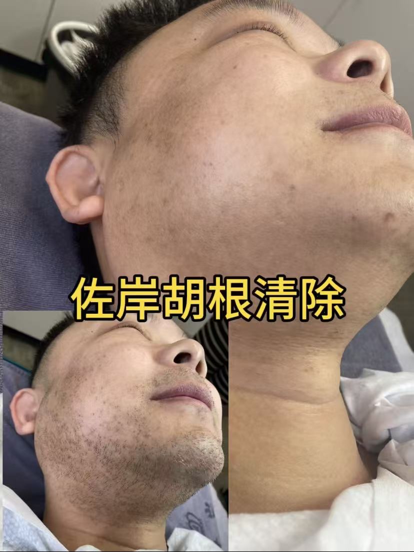 嘉兴脱毛
